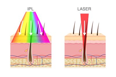 Depilación láser y depilación IPL