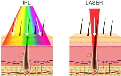 depilación laser vs IPL
