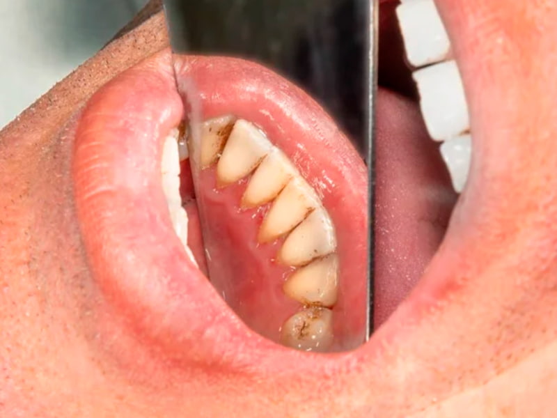 manchas negras en los dientes que no son caries