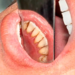 manchas negras en los dientes que no son caries
